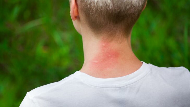 Photo of mosquito bites on the back of the neck of a person